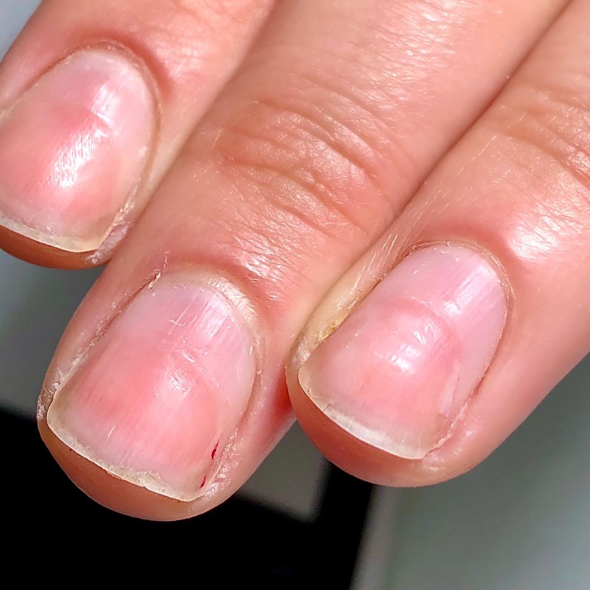 Uña con Aro de Fuego. Uña con Aro de Fuego.