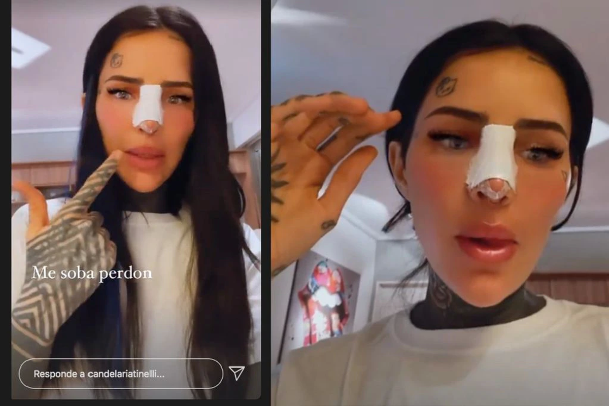 ¡Se la jugó! Cande Tinelli volvió a operarse la cara y mostró cómo quedo: 