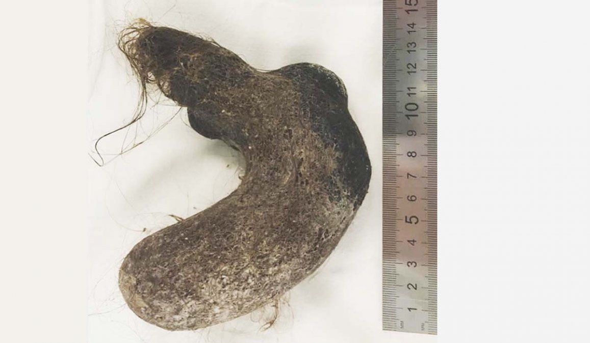 Luego de realizarle a la niña una endoscopía y una imagen de rayos x, los médicos operaron a la niña y ñe extrajeron la enorme bola de pelos