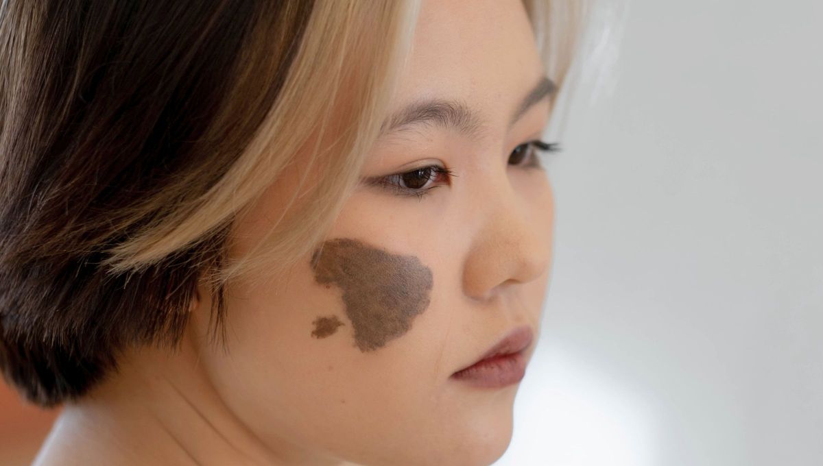 Qué significa tener una mancha de nacimiento en la cara