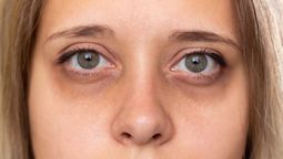 ¿Cómo eliminar las ojeras oscuras con los productos correctos?