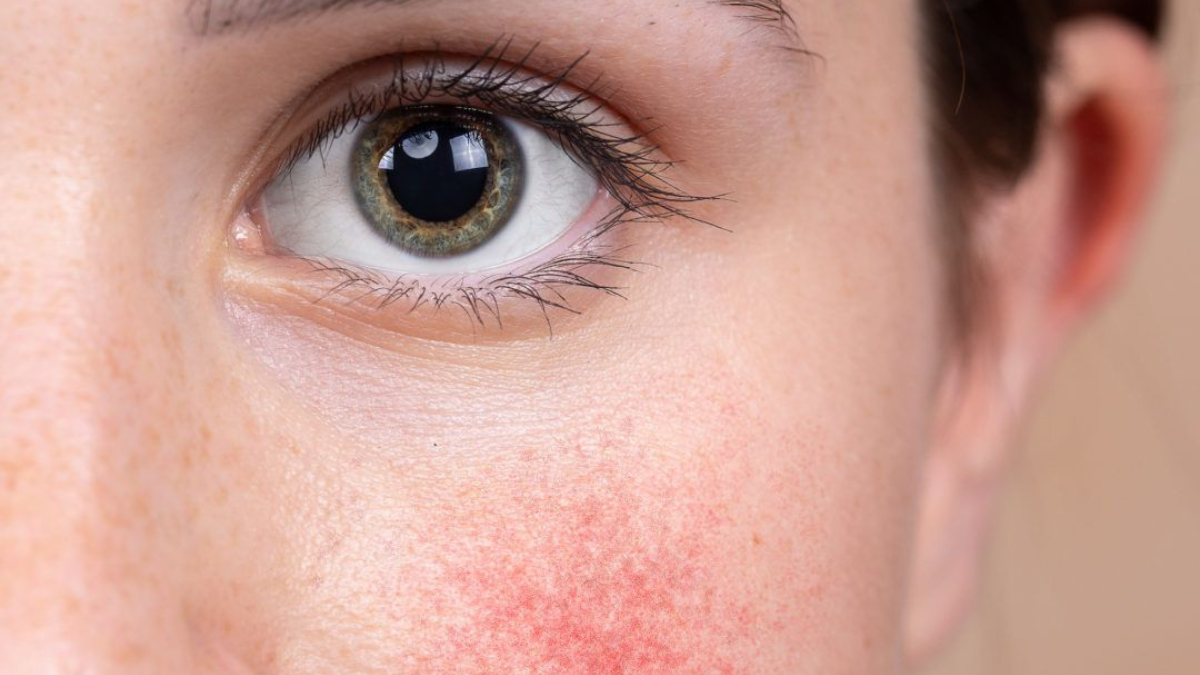 Este truco con aloe vera te ayudará a calmar la zona. Puedes utilizar este gel cada vez que necesites porque es 100% natural.