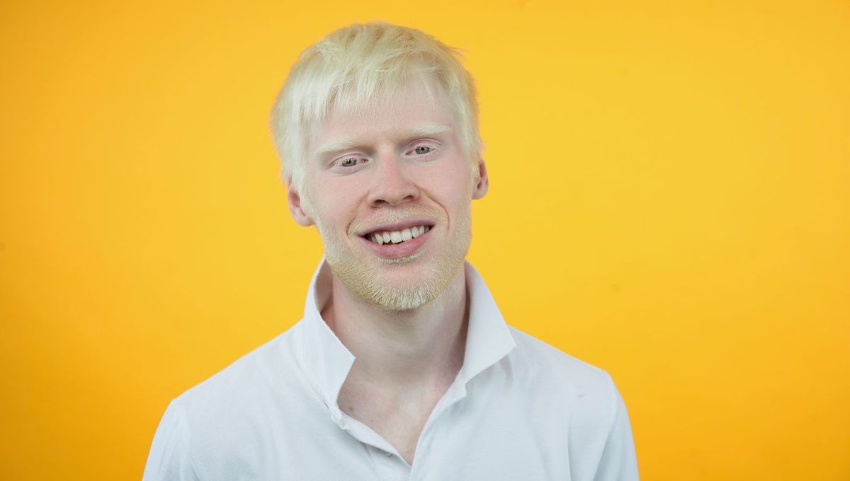 Persona con albinismo Persona con albinismo