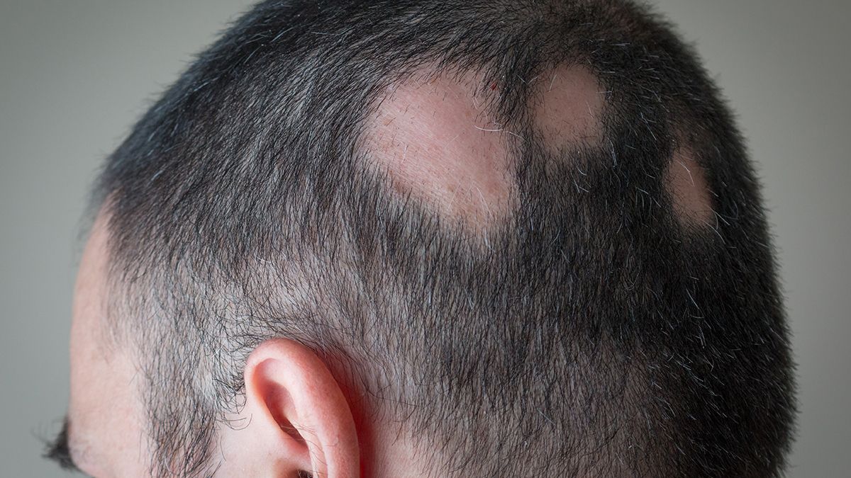Un caso típico de alopecia areata.