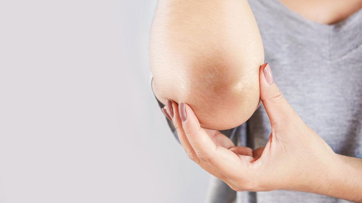 Con un simple truco de belleza, se puede solucionar el mal de los codos negros.