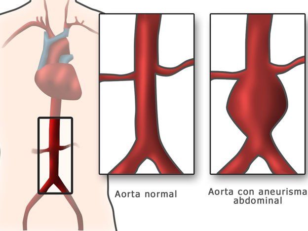 Médicos recomiendan controles periódicos para prevenir aneurisma de aorta
