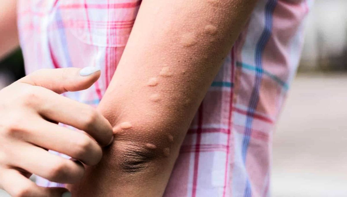 Las picaduras pueden generar picazón, ardor e irritación