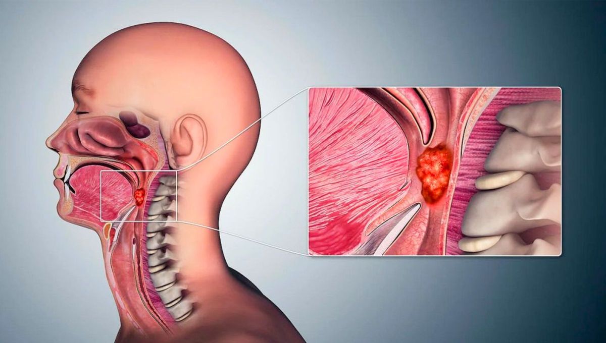 Imagen alusiva al Cáncer de Cabeza y Cuello Imagen alusiva al Cáncer de Cabeza y Cuello