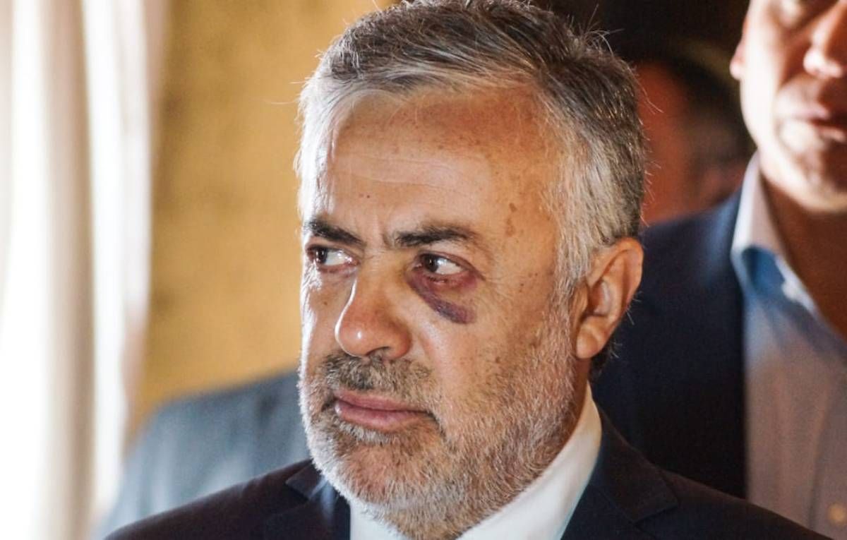 Alfredo Cornejo fue operado en el ojo y por la intervención tiene un ojo morado.