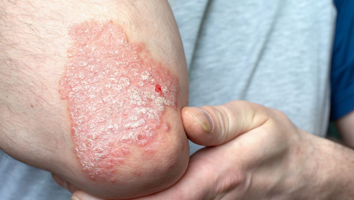 Psoriasis. Psoriasis.