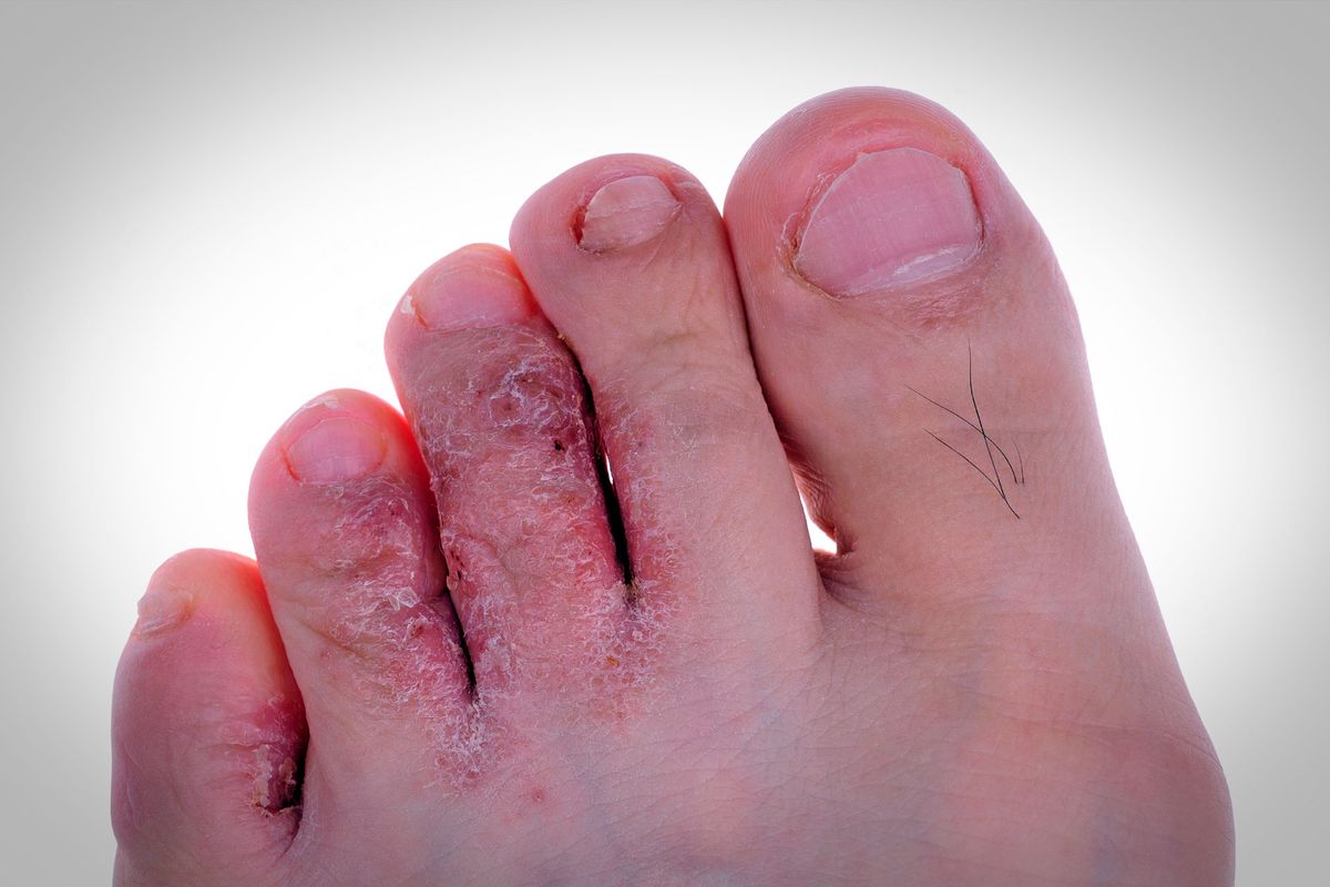 Los hongos en los pies pueden manifestarse con una variedad de síntomas Los hongos en los pies pueden manifestarse con una variedad de síntomas