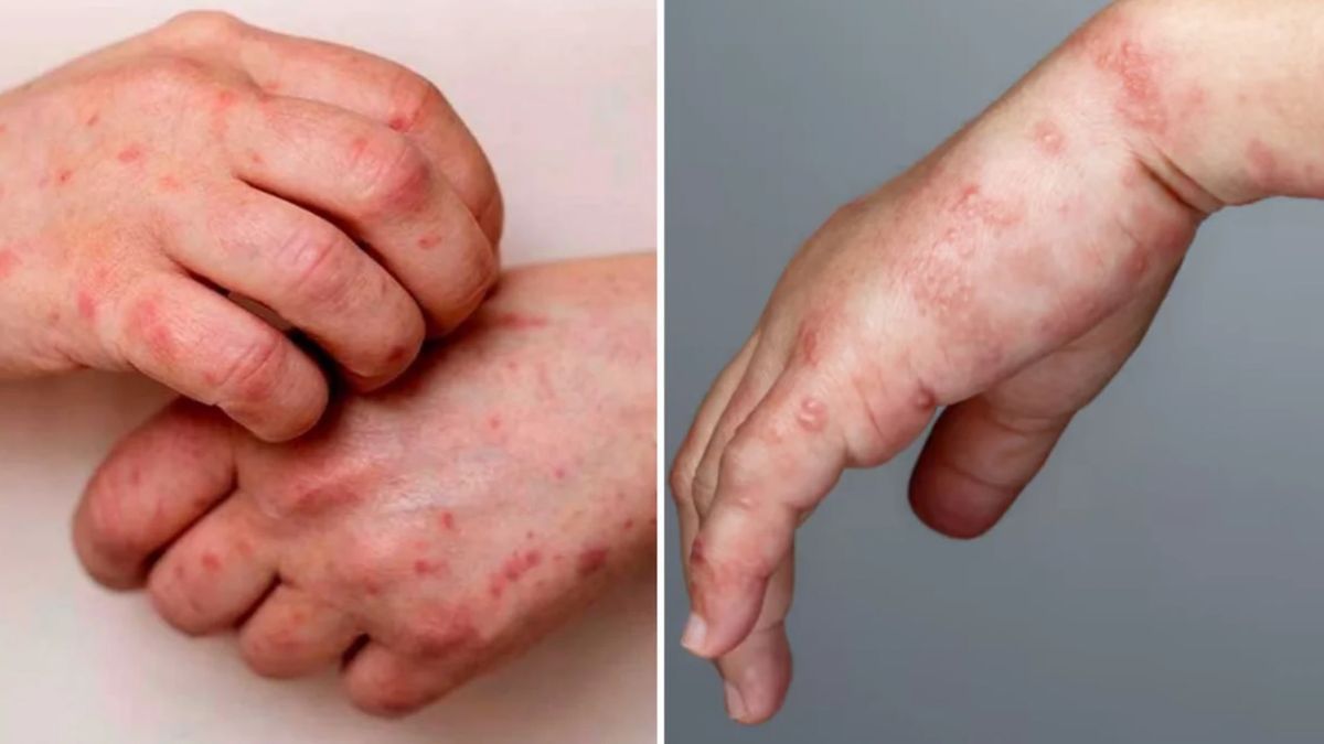 Viruela símica y herpes zóster: ¿cuáles son las diferencias?