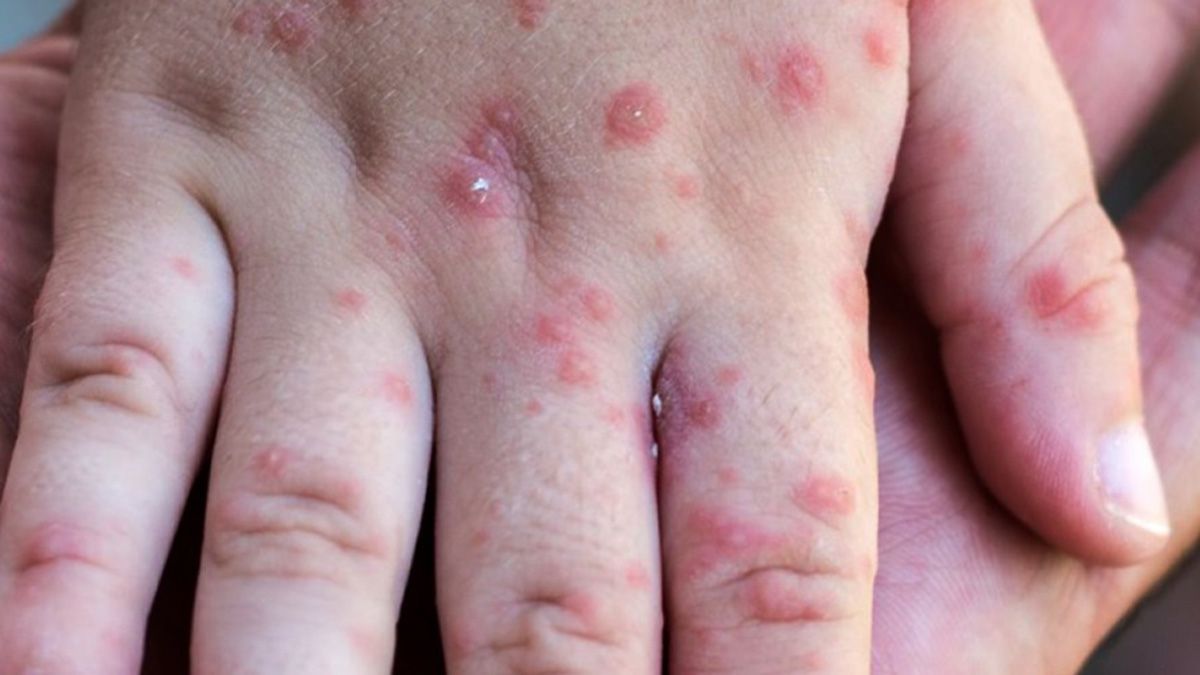 Los casos de Viruela del Mono en el mundo han provocado alerta en las autoridades.
