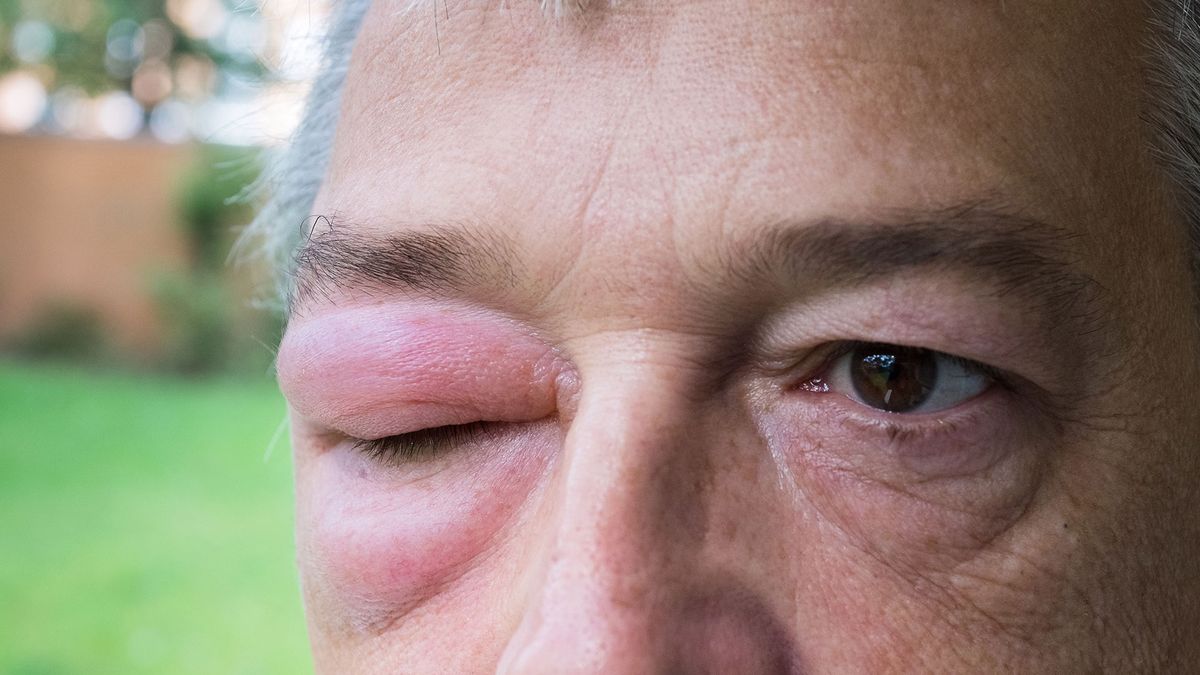 Los familiares de las personas que padecen Angioedema hereditario destinan hasta 25 días al mes para asistirlos Los familiares de las personas que padecen Angioedema hereditario destinan hasta 25 días al mes para asistirlos