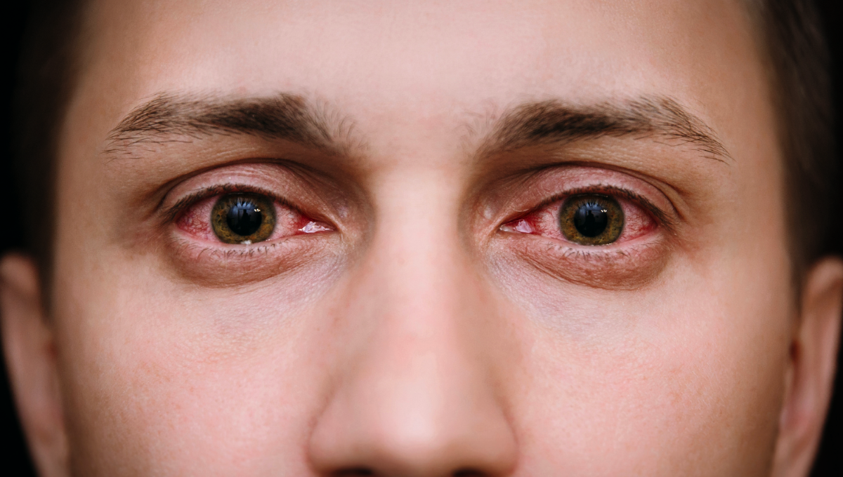 La conjuntivitis es una enfermedad molesta en la que se inflama la membrana transparente y delgada del ojo