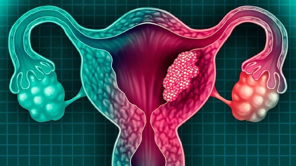 Cáncer de cuello uterino: principales recomendaciones para prevenir la enfermedad