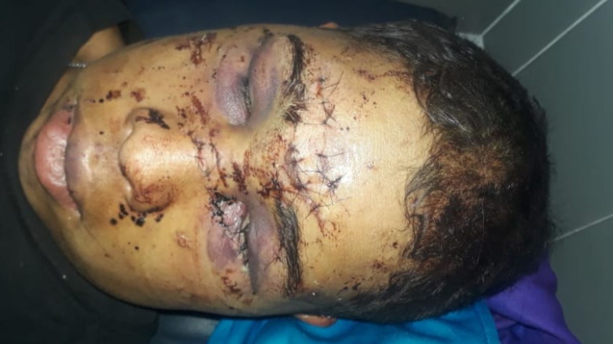 Así quedó el rostro del chico agredido en El Algarrobal, Las Heras.