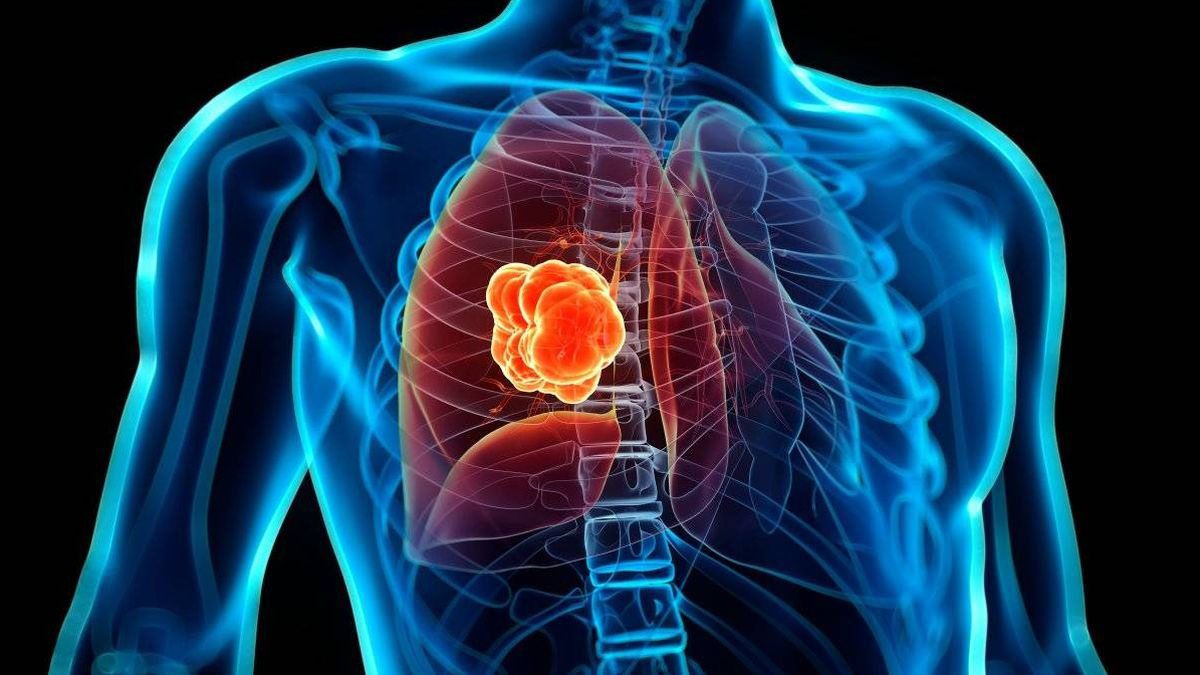 El cáncer de pulmón tiene un nuevo tratamiento aprobado por ANMAT.