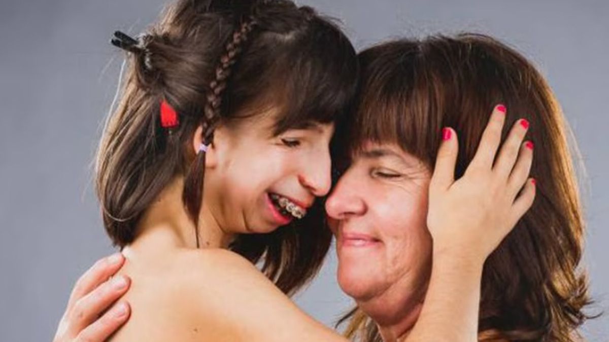 El Día Internacional del Síndrome de Treacher Collins se celebra este 28 de mayo. Afecta a 2 de 100.000 nacimientos en el mundo