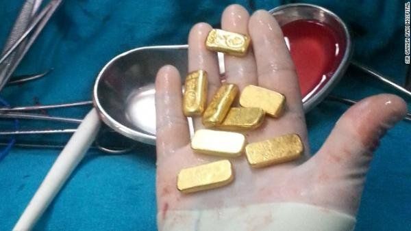 Se quejaba de dolores en el estómago, lo operaron y le extrajeron 12 lingotes de oro