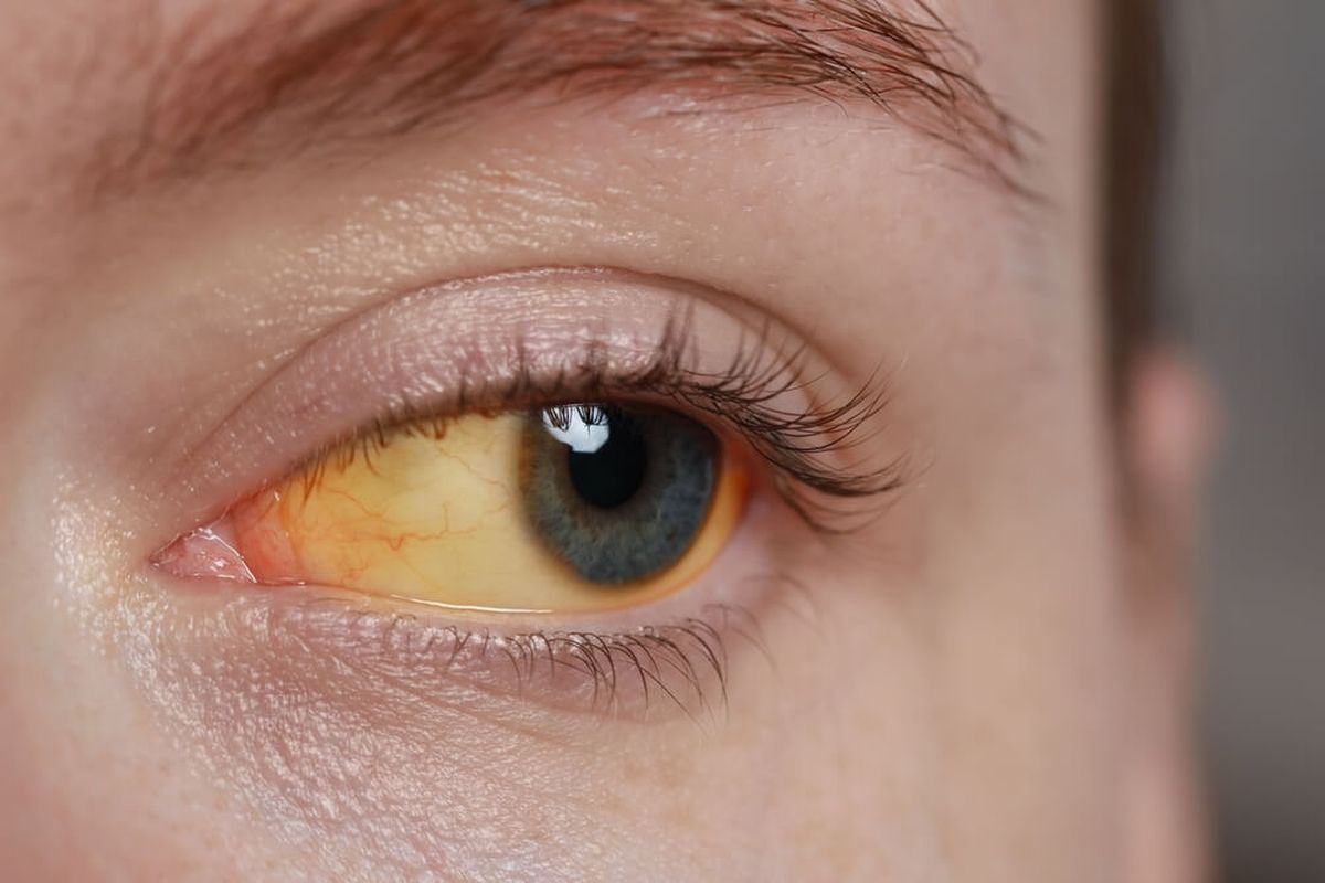 Ojos amarillos: qué significan según la medicina Ojos amarillos: qué significan según la medicina