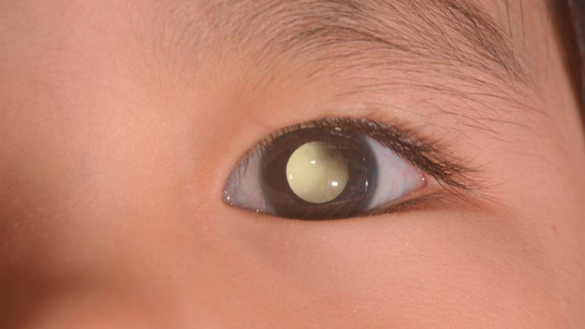 El cáncer de ojo pediátrico diagnosticado de forma tardía puede provocar metástasis a otros órganos El cáncer de ojo pediátrico diagnosticado de forma tardía puede provocar metástasis a otros órganos