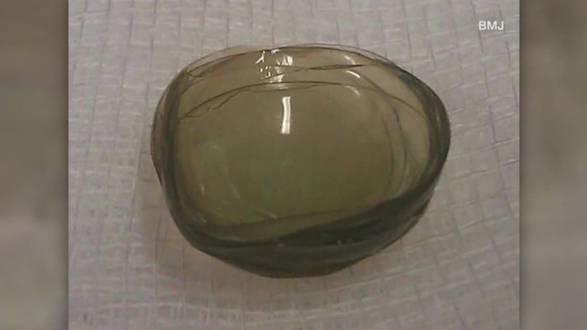 La cirugía fue suspendida de inmediato. La cirugía fue suspendida de inmediato. 