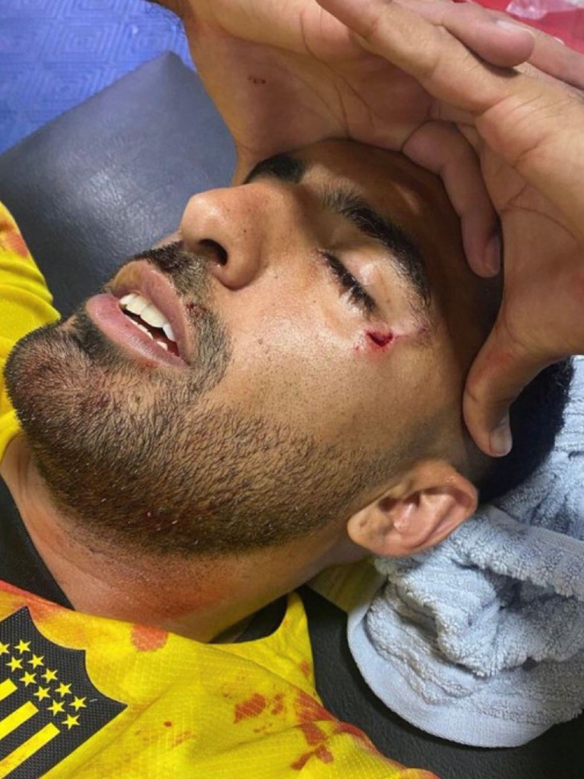 Así quedó el rostro de Maximiliano Olivera, jugador de Peñarol, tras el piedrazo recibido desde la hinchada de Rosario Central. Así quedó el rostro de Maximiliano Olivera, jugador de Peñarol, tras el piedrazo recibido desde la hinchada de Rosario Central.