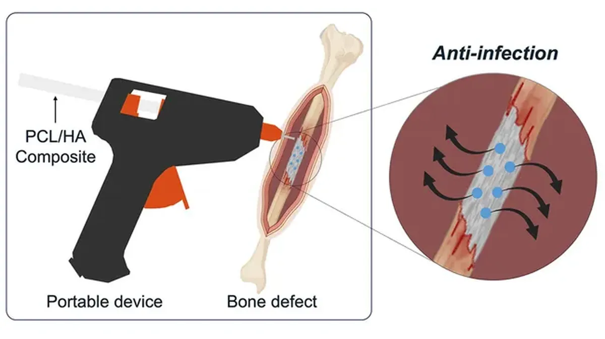 Este invento podríar revolucionar el tratamiento de fracturas.