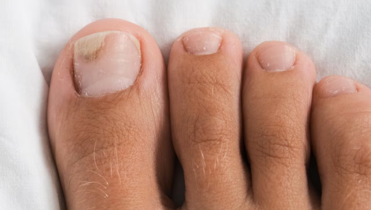 Cómo eliminar los hongos de los pies usando orégano y ajo