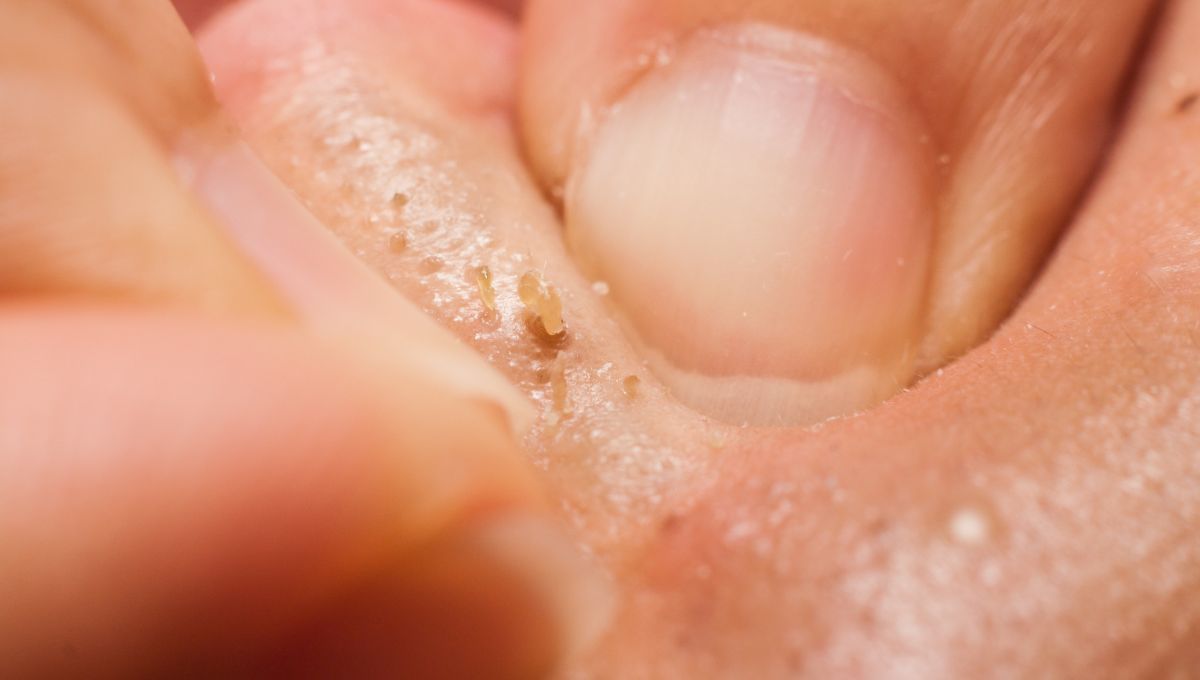 Puntos negros. Puntos negros. 