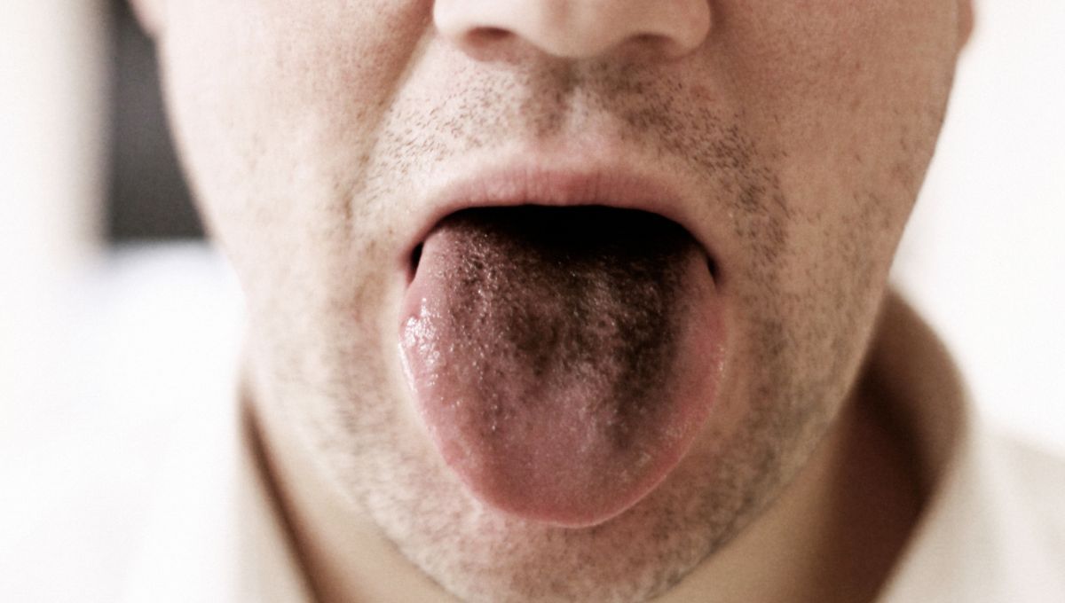 Lengua negra. Lengua negra.