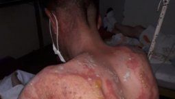 El joven quemado, de 32 años, es oriundo de La Paz. Se recupera en el hospital del Este.