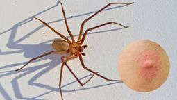 La picadura de la araña violinista puede ser diferenciada fácilmente.&nbsp;
