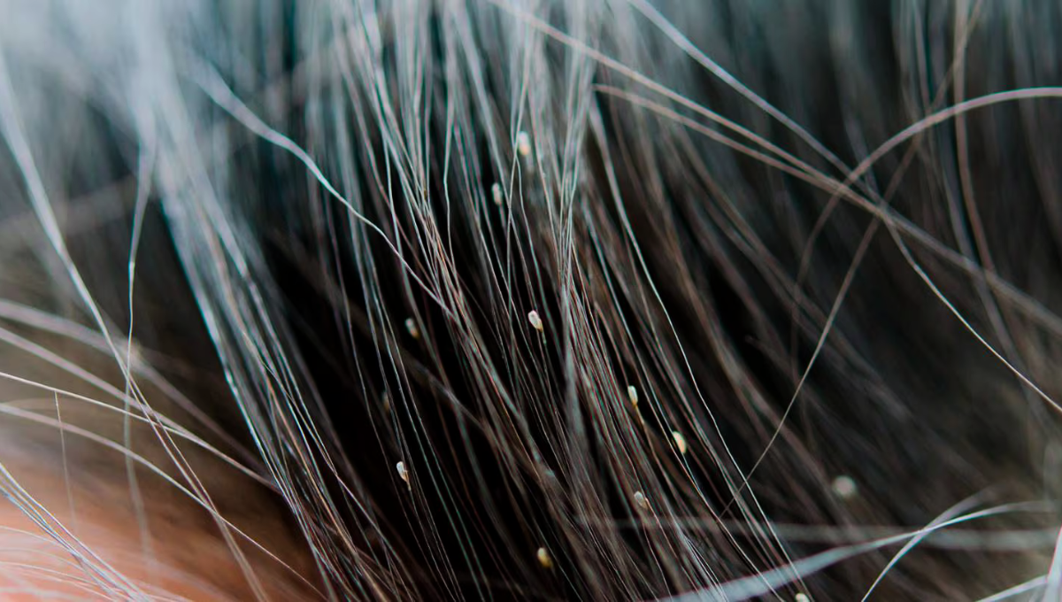 Los piojos y las liendres son de f&aacute;cil propagaci&oacute;n, pero muy dif&iacute;ciles de eliminar.