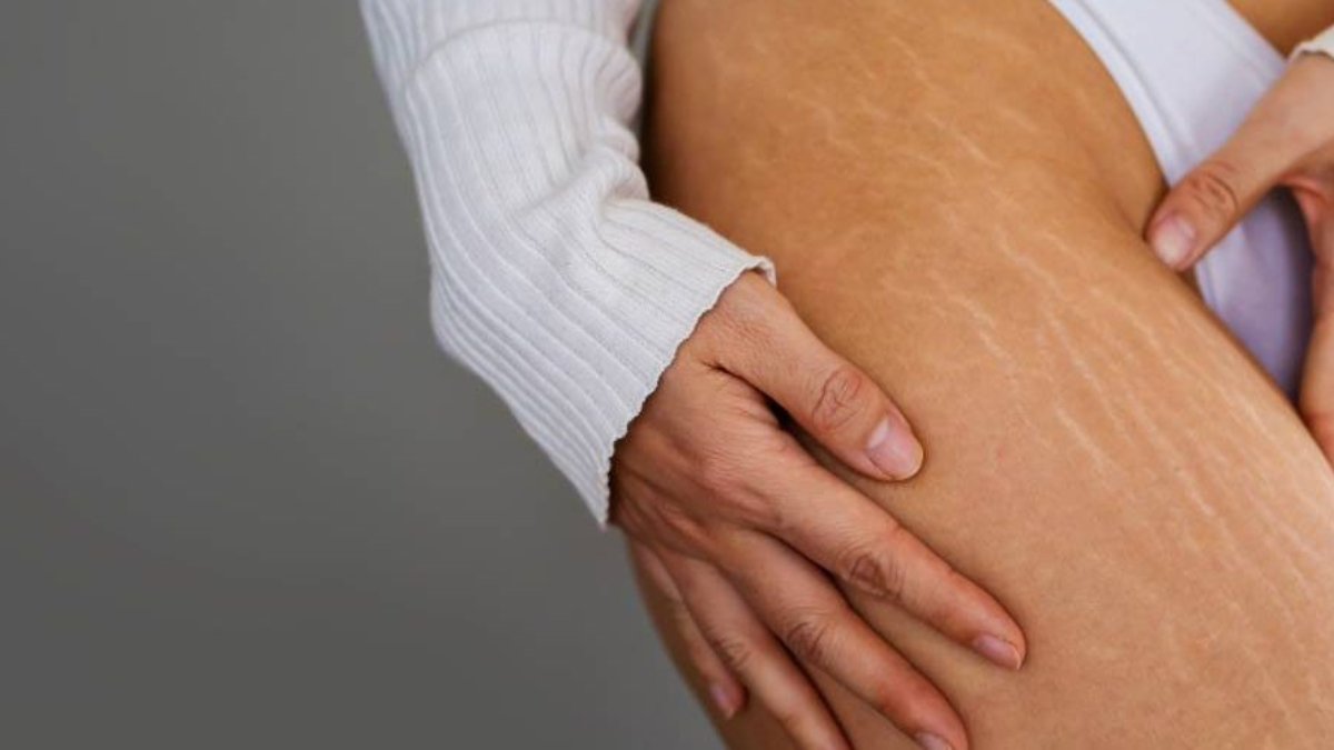 Mercadona tiene el potente aceite de rosa mosqueta que te ayudará a reducir las estrías en la piel. Mercadona tiene el potente aceite de rosa mosqueta que te ayudará a reducir las estrías en la piel.