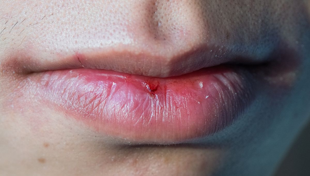 La boca seca y los labios partidos suelen darse por consumir bebidas como café o té. La boca seca y los labios partidos suelen darse por consumir bebidas como café o té. 