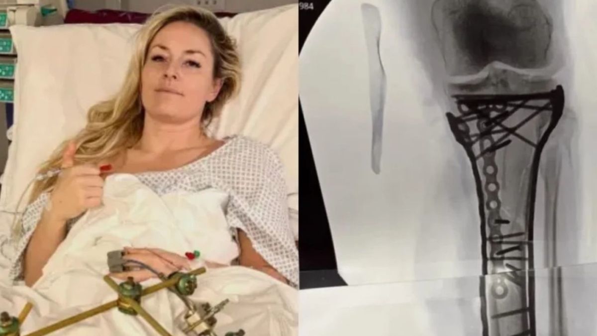 Juegos Olímpicos: salvaron a Lindsey Vonn de una amputación tras el accidente