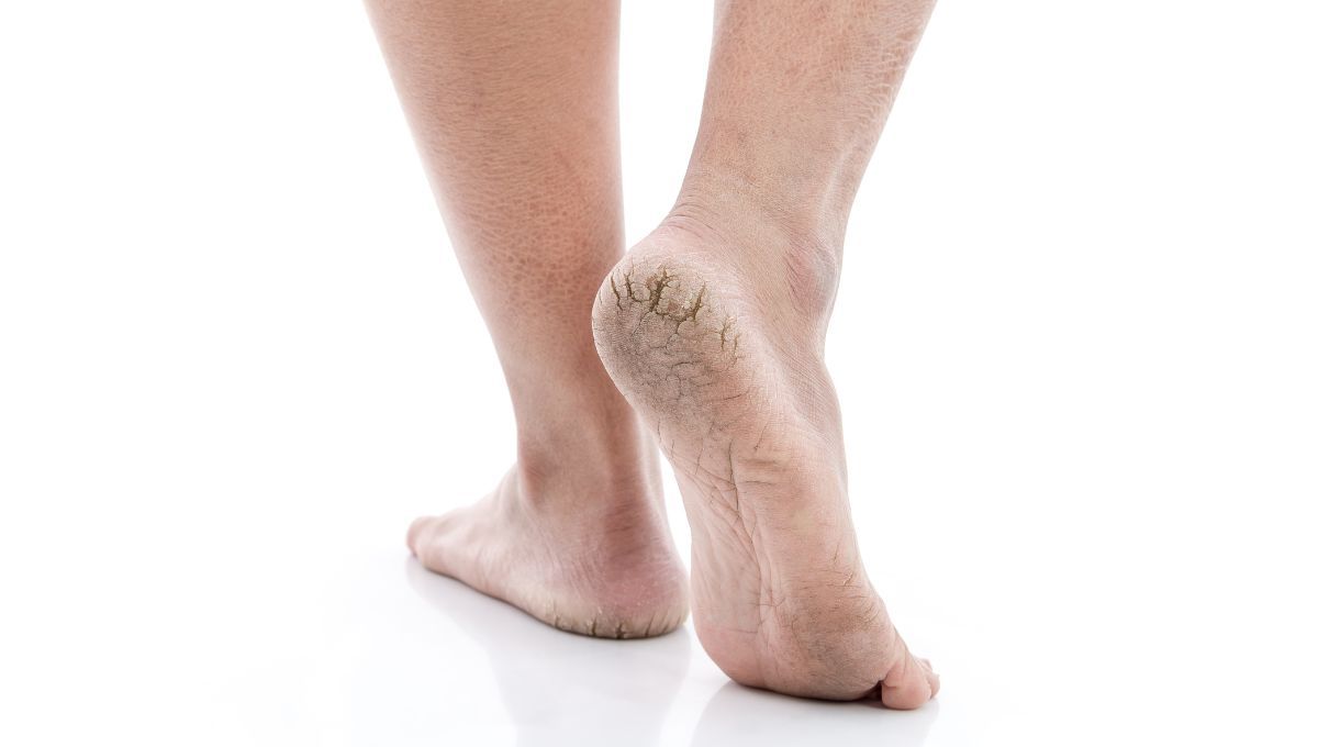 Talones agrietados. Talones agrietados.