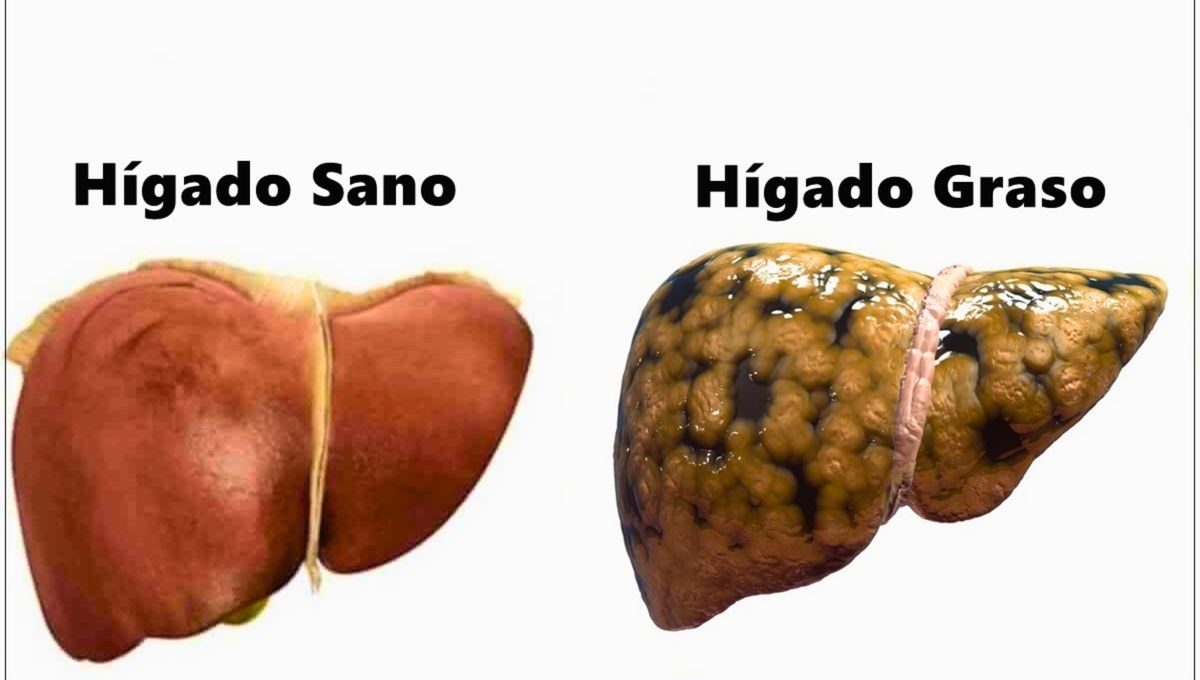 El hígado graso, también conocido como esteatosis hepática, es una condición cada vez más común en personas de todas las edades. Se produce cuando se acumula grasa en las células del hígado, afectando su correcto funcionamiento. El hígado graso, también conocido como esteatosis hepática, es una condición cada vez más común en personas de todas las edades. Se produce cuando se acumula grasa en las células del hígado, afectando su correcto funcionamiento.