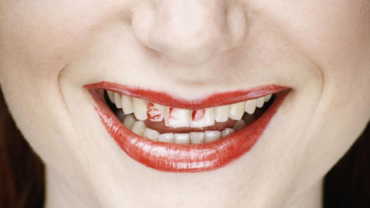 Manchas de labial en los dientes. Manchas de labial en los dientes.