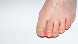 ¿Cómo quitar o eliminar los hongos de los pies?