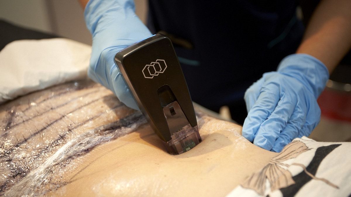 El Morpehus 8 es el único tratamiento antiage que actúa sobre el tejido subdérmico corporal y facial para tensar la piel. El Morpehus 8 es el único tratamiento antiage que actúa sobre el tejido subdérmico corporal y facial para tensar la piel.