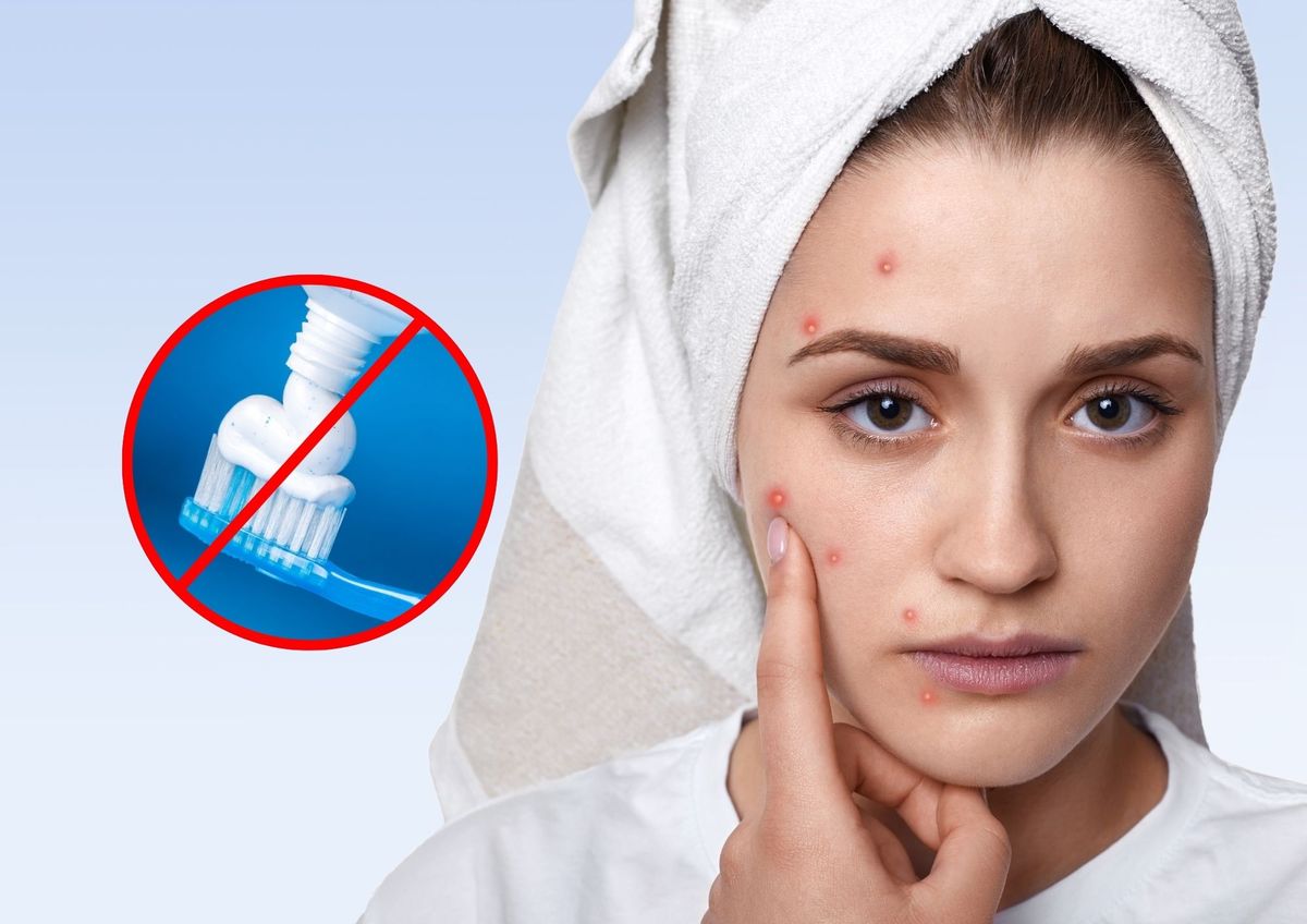 El acné debe tratarse siempre con asesoramiento médico