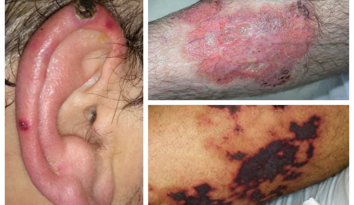 Cocaína adulterada. Advierten por cocaína adulterada que daña la piel y las orejas.