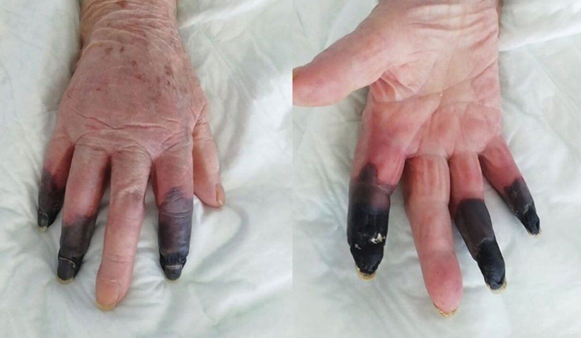 La mujer italiana de 86 años dio positivo de Covid-19 y sufrió una complocación vascular provocándole gangrena de los dedos de la mano derecha