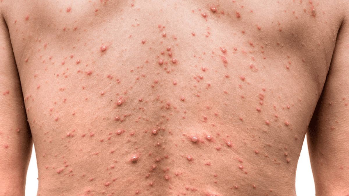 La viruela símica puede afectar a cualquier persona que entre en contacto con una persona enferma o contacto físico directo como la relación sexual