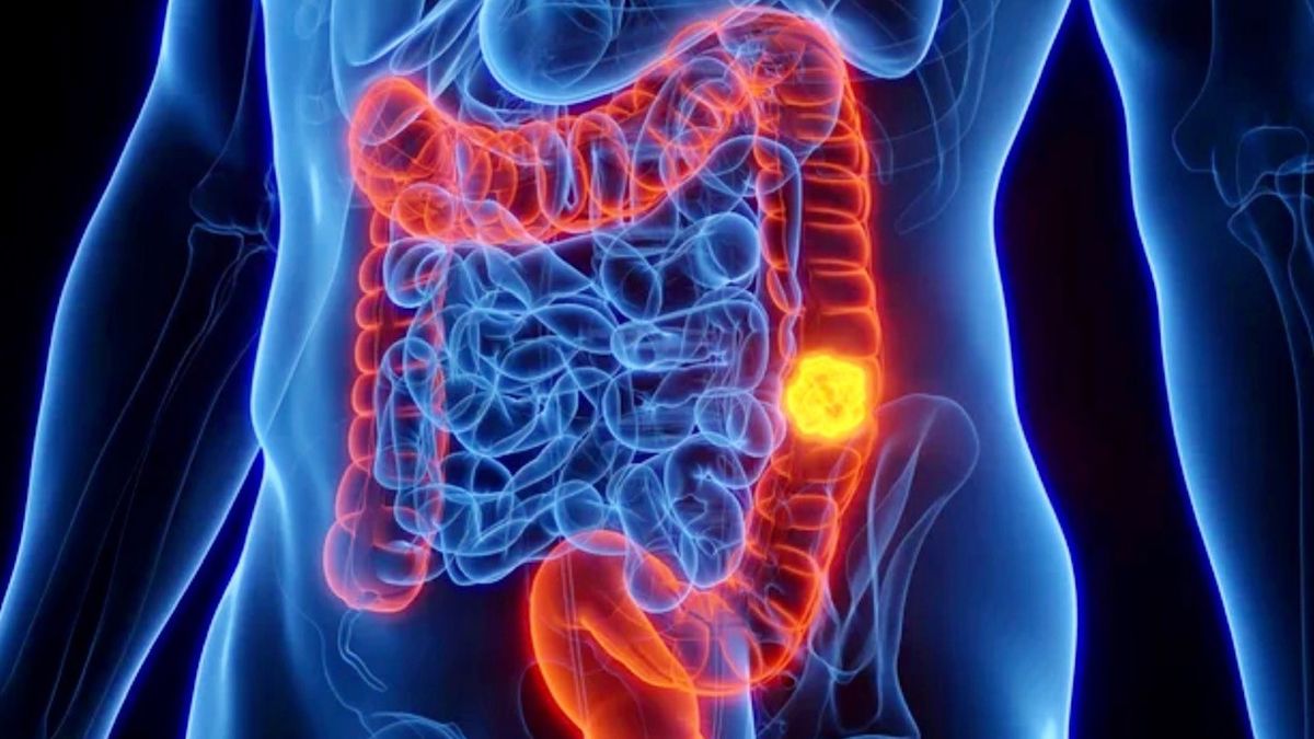 Cáncer de colon: crearon un modelo de inteligencia artificial que acelera el diagnóstico