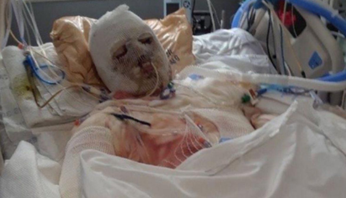 El transplante llevó 23 horas de cirugía.