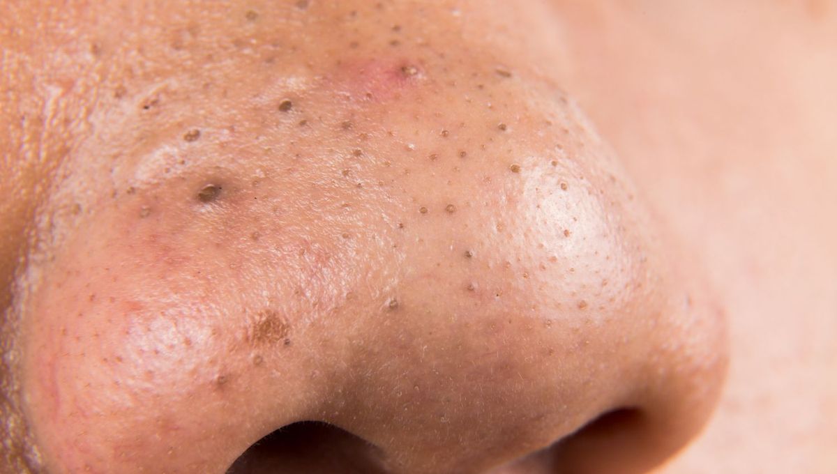 Acné, puntos negros. Acné, puntos negros.